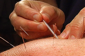 Acupuncture is effective for pain management and stimulation of tissue repair