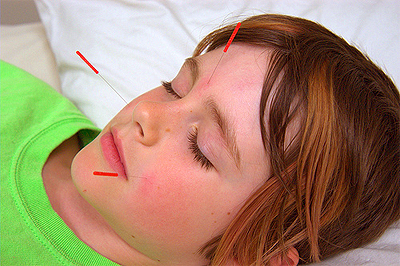 Acupuncture for children