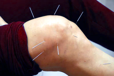 Prolo-acupuncture treatment at the knee - WestHollywoodAcupuncturist.com